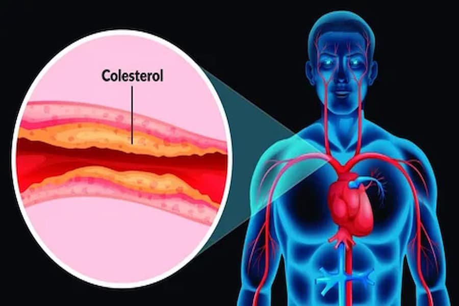 Cholesterol